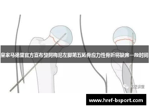 皇家马德里官方宣布楚阿梅尼左脚第五跖骨应力性骨折将缺席一段时间
